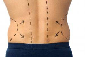 vaser Liposuction Cosmetic Surgery