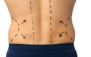 Liposuction Cosmetic Surgery