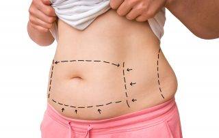 The Difference Between a Tummy Tuck and Liposuction