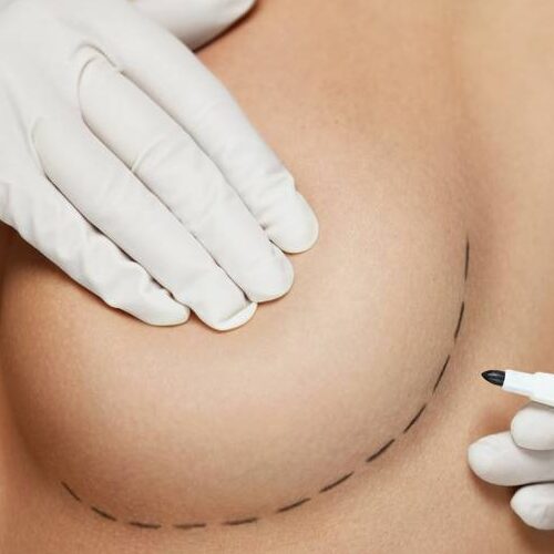 What to Expect After a Breast Augmentation