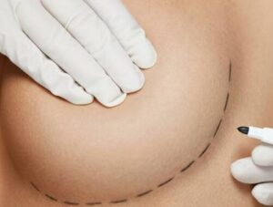 What to Expect After a Breast Augmentation fat transfer breast augmentation