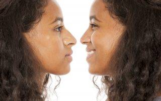 Things to Know About wide nose Rhinoplasty