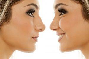 Rhinoplasty Procedure