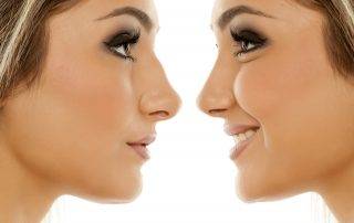 Rhinoplasty Procedure