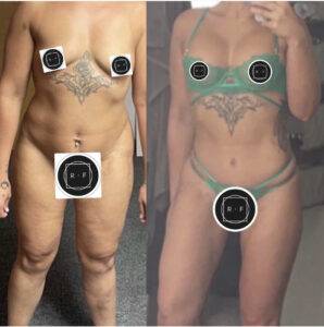 mummy makeover uk before and after 2 pictures