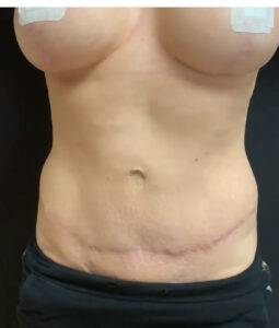 mummy makeover results