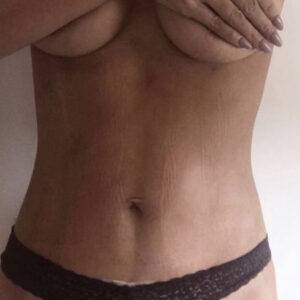 mummy makeover tummy tuck