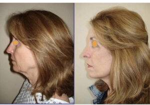 facelift before and after