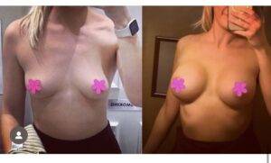 boob job before and after