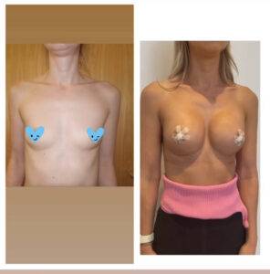 boob job before and after
