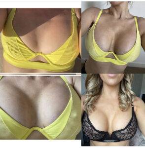 boob job before and after