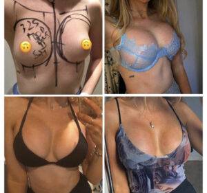 4 images of a boob job before and after