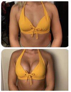 boob job before and after yellow biniki