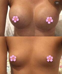 picture of a boob job before and after