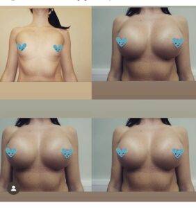 dr frati boob god results of a boob job, before and after