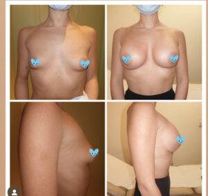 boob job before and after