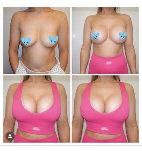 boob job before and after