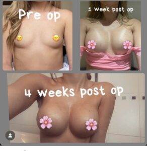 boob job before and after