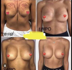 boob job before and after