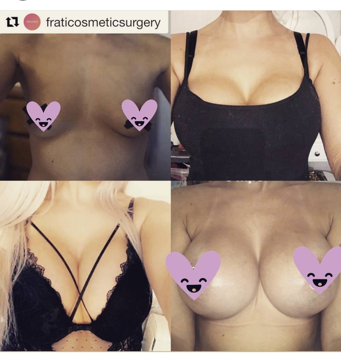 boob job before and after