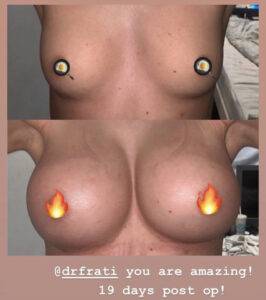 boob job before and after