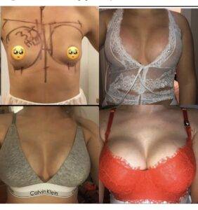 boob job before and after