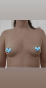 boob job before and after