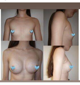 boob job before and after