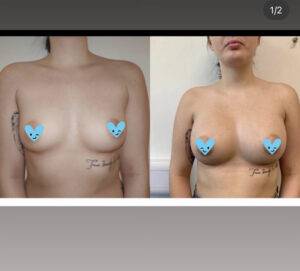 boob job before and after