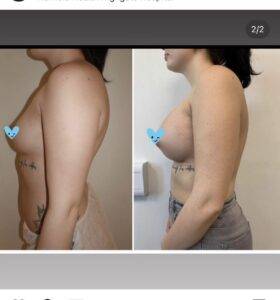 boob job before and after
