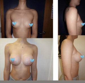 boob job before and after