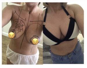 boob job before and after