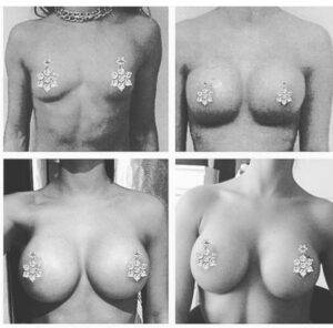 boob job before and after 4 images