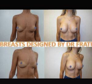 boob job before and after by dr Frati