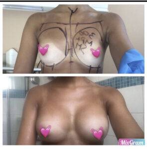 boob job before and after 2 images