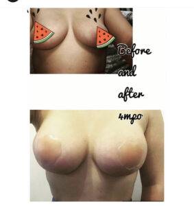 boob job before and after