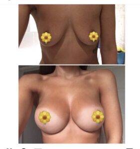 boob job before and after