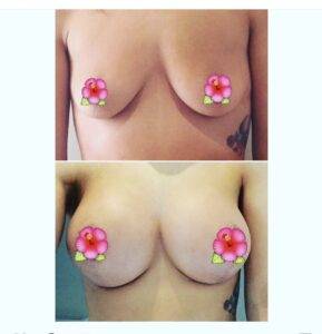 boob job before and after