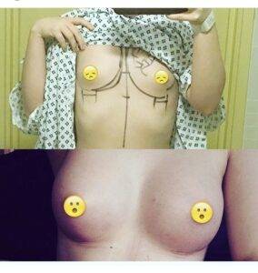 boob job before and after picture