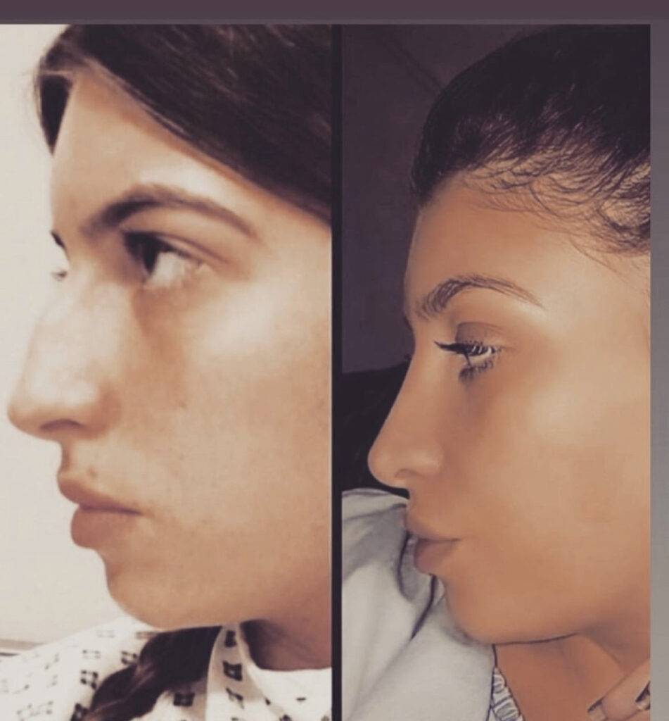 nose job before and after on a woman by dr frati