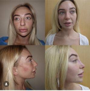 four images of a woman with a nose job before and after