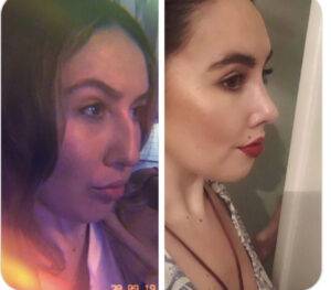 nose job before and after 2 pictures septorhinoplasty procedure