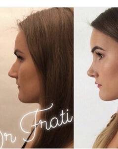 nose job before and after on a woman
