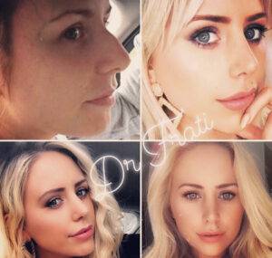 4 photos of a nose job before and after