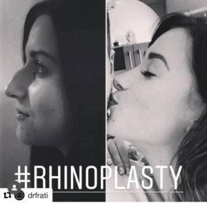 open nose job before and after