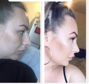 closed rhinoplasty nose job before and after