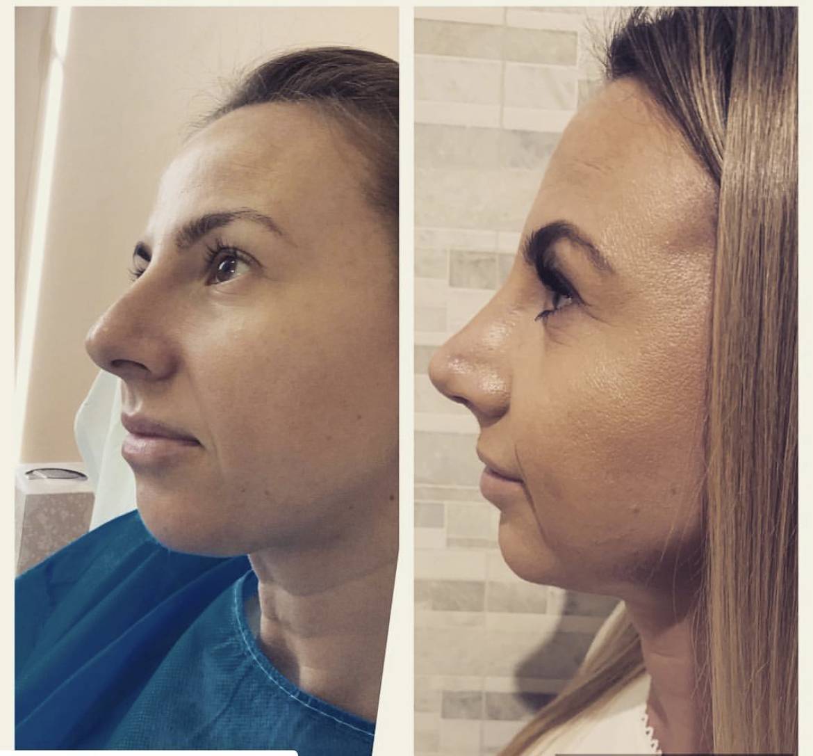 nose job before and after by Dr Frati rhinoplasty in Manchester