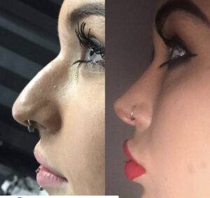 nose job before and after