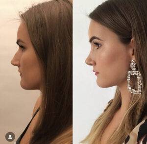 nose job before and after on a woman with a large earring