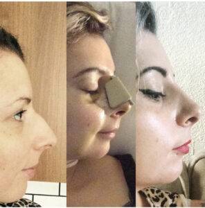 3 photos of a nose job before and after she is asking is rhinoplasty dangerous